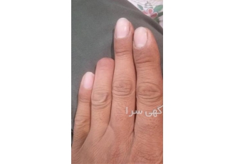 انگشت مصنوعی دست و پا آریاپایا