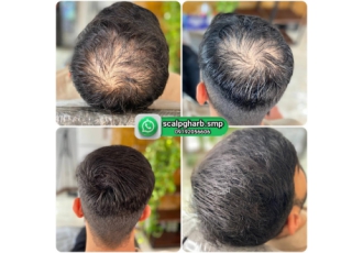 رفع کمپشتی موها با میکرواسکالپ