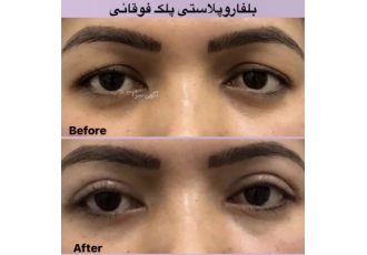 عمل افتادگی پلک(بلفاروپلاستی)