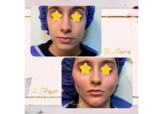 تزریق چربی صورت جهت زاویه سازی روش zwnj های زیادی برای جوانسازی