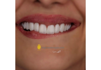 کامپوزیت و لمینت دندان کامپوزیت و لمینت دندان با تخفیف ویژه زیر نظر