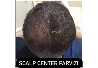 میکرواسکالپ بهترین جایگزین برای کم مویی با میکرواسکالپ دیگه نگران کم