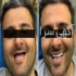 ایمپلنت دندان با بیمه پارسیان : مناسب ترین تعرفه در تهران ایمپلنت