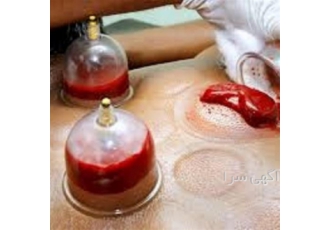 دوره آموزش حجامت با مدرک