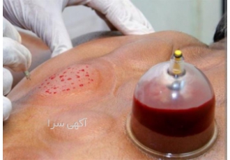 آموزش زالو درمانی توسط اساتید مجرب