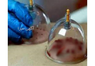 دوره ی آموزشی حجامت آموزش بادکش زالو درمانی در تهران آموزش تا 0 تا