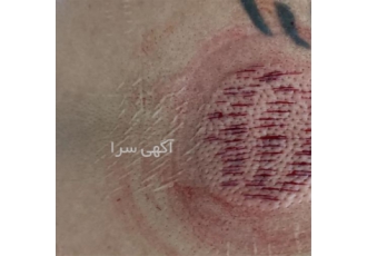 آموزش کامل حجامت ، فصد خون ، طب سوزنی ، نبض شناسی