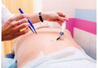 آموزش تخصصی حجامت و بادکش و زالو درمانی