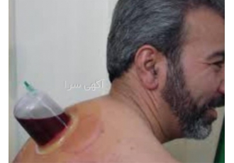 آموزش حجامت با کیفیت درجه یک در اراک آموزش حجامت بادکش درمانی و زالو