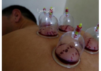 دوره آموزش بادکش و حجامت