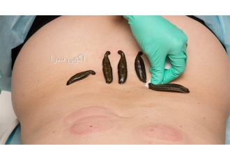 آموزش زالو درمانی ، حجامت ، پاکسازی پوست