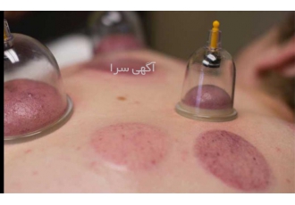 برگزاری دوره آموزشی طب سنتی با مدرک - آموزش حجامت