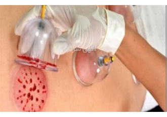 دوره آموزش حجامت دوره تزریقات طب سوزنی در سلطانیه مژده به علاقمندان