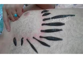 دوره آموزش زالو درمانی حضوری و غیر حضوری در تهران دوره آموزش زالو