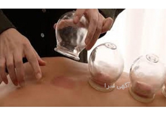 دوره آموزش حضوری بادکش با اعطای مدرک