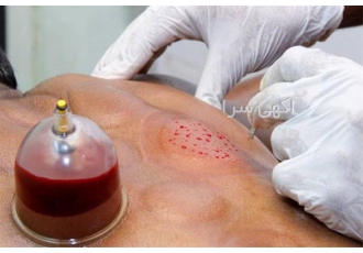 صفر تا صد دوره آموزشی حجامت / زالو درمانی / بادکش