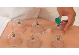 آموزش حجامت زالودرمانی بادکش دو روزه در تهران اموزش کارگاهی حجامت