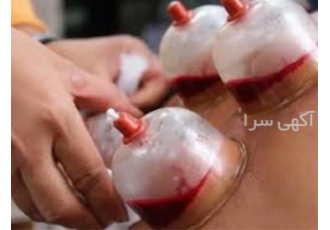 آموزش حجامت و زالو درمانی و بادکش حضوری و آنلاین