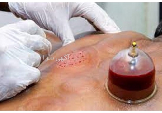 آموزش حجامت و کاربرد های آن به صورت عملی
