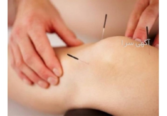 آموزش طب سوزنی حرفه ای و کاربردی به صورت عملی در کرمانشاه آموزش طب سنتی