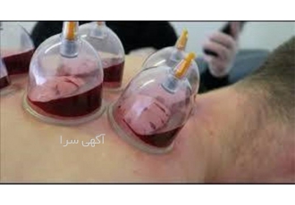 دوره‌های تخصصی حجامت با تدریس برترین استادان طب سنتی