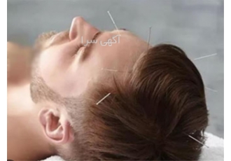 یادگیری طب سوزنی با مدرک بین المللی
