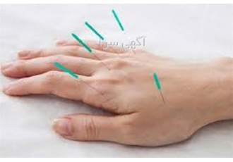 آموزش طب سوزنی به صورت حضوری و آنلاین در تهران دوره آموزش طب سوزنی