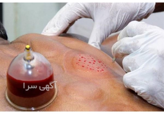 آموزش حجامت / زالو درمانی / بادکش در تهران دوره آموزشی حجامت و زالو