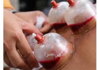 دوره آموزش حجامت حضوری و آنلاین با اعطای مدرک در تهران دوره آموزش حجامت