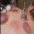 دوره حجامت و بادکش تخصصی اعطای مدرک حجامت در ساری دوره حجامت و بادکش