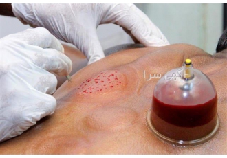 دوره آموزشی حجامت در تهران به نام خدا دوره آموزشی نظری عملی حجامت