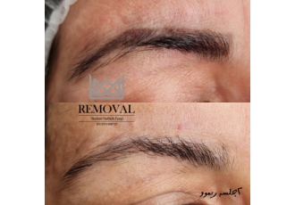 پاک کردن میکروبلیدینگ ابرو در تهران باتخصصی ترین روشها