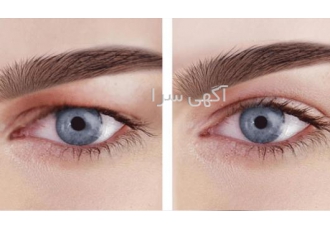 پکیج زیبایی چشم رفع پف چشم وسیاهی زیر چشم اگر میخواهید برای همیشه