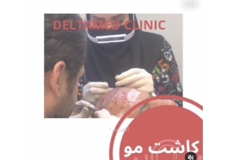 کاشت مو و ابرو کلینیک دلتامد کاشت مو و کاشت ابرو کاشت ابرو و ریش به روش