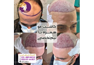 آفر استثنایی کاشت مو و ابرو آفر استثنایی کاشت مو و ابرو 30% تخفیف