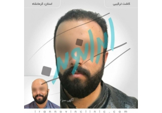 &quot;کاشت مو در ایران نوین تنها با دو و نیم میلیون تومان&quot;