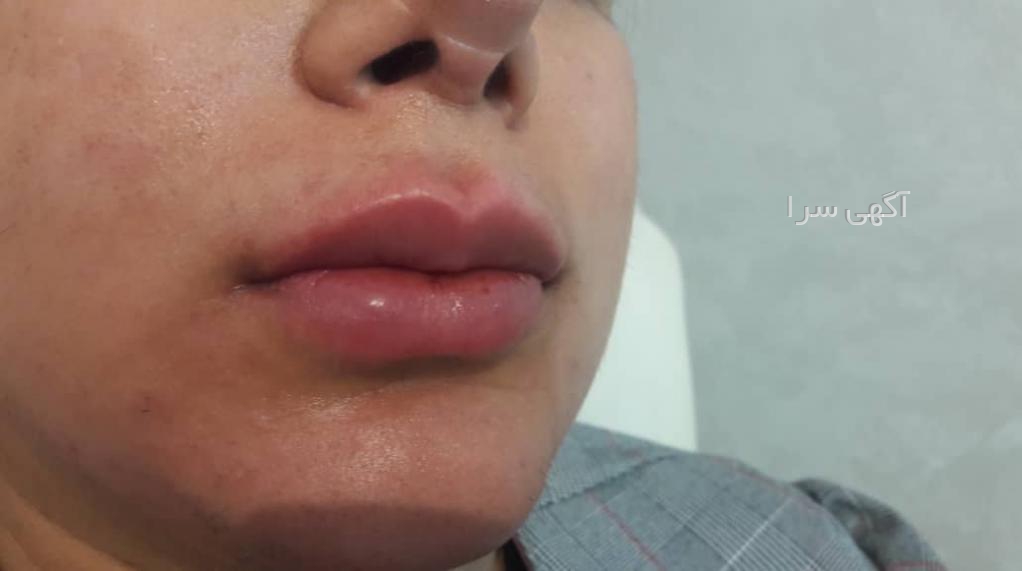 خدمات ژل لب