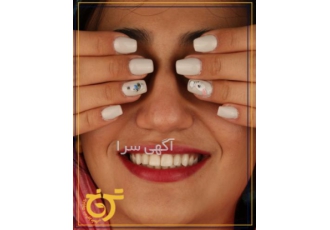 لمینت در شرق تهران | دندانپزشکی ترنج و یا unique smile لمینت