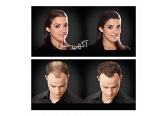 اگر دغدغه کم پشتی موهایتان را دارید تاپیک چاره شماست پودر پرپشت کننده