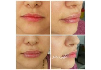 تزریق ژل لب لب یکی از قسمت های صورت است که با افزایش سن حجم لب کم شده