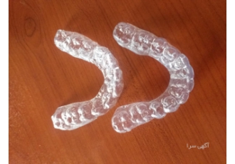 ساخت نایتگارد و نایت گارد فوری در شهرک غرب | درمان دندان قروچه 🦷