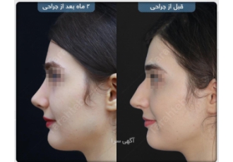 عمل بینی عمل زیبایی بینی یکی از رایج ترین و شایع ترین جراحی های پلاستیک