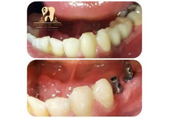 دندانپزشکی تخصصی دکتر فیاضی ⭐ ارتودنسی ایمپلنت کامپوزیت آیا به دنبال