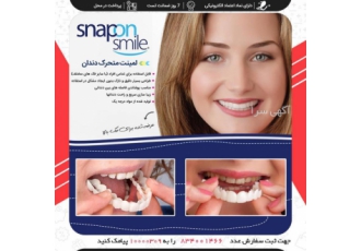 لمینت متحرک دندان - Snap On Smile