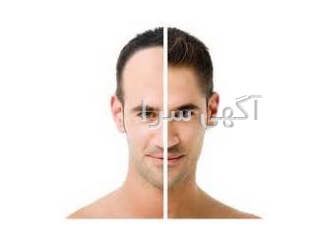 کاشت موی اقساطی در تهران | بهترین قیمت و ضمانت کتبی 💯 آیا رویای داشتن