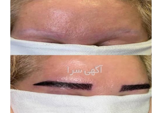کاشت ابرو و موی طبیعی و دائمی | خط رویش حرفه‌ای ✨ آیا به دنبال زیبایی