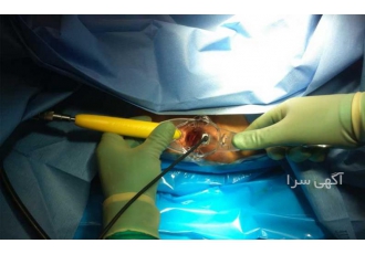 لیزر بواسیر یا هموروئید در کلینیک پایتخت امروزه روش لیزر بواسیر