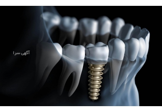 انجام ایمپلنت دندان لیزری به صورت یک روزه و فوری ایمپلنت دندان