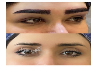 کاشت ابرو طبیعی ✨ | جوانسازی لیزر و بوتاکس تخصصی به کلینیک زیبایی ما