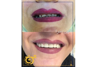 کامپوزیت ونیر در تهران | دندانپزشکی خوب در تهران کامپوزیت ونیر در تهران